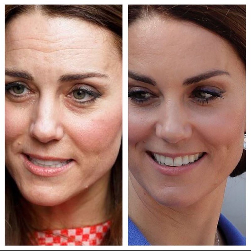 Έκανε botox η Kate Middleton; - εικόνα 1