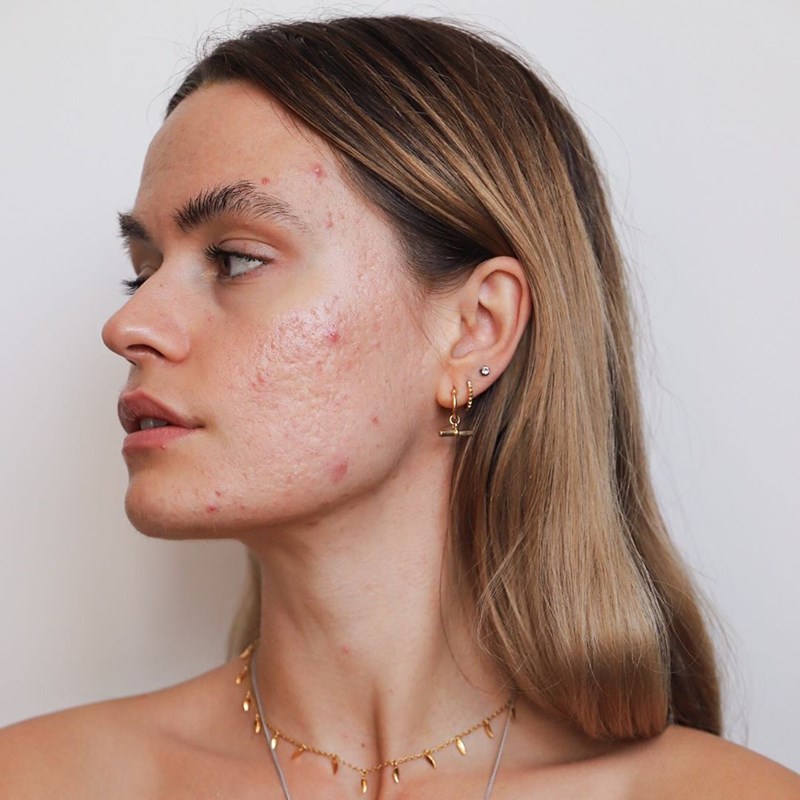 Οι beauty bloggers που δεν φοβούνται να δείξουν πως έχουν ακμή - εικόνα 1