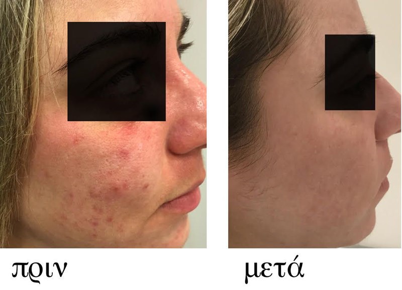 Τέλος στην ακμή! Απαλλαγείτε για πάντα από τα σπυράκια με τη μέθοδο της Δρ. Ξανθινάκη - εικόνα 2