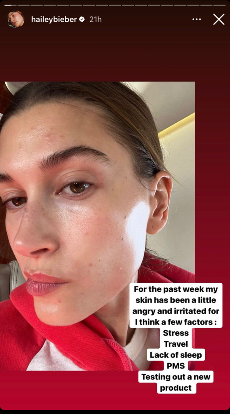 Hailey Bieber: Η αποτελεσματική κρέμα που επιλέγει για να καταπολεμήσει την ακμή - εικόνα 1